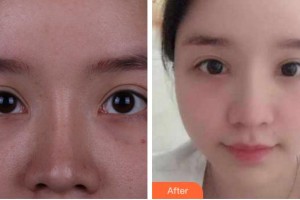 寧波尚麗整形美容醫(yī)院安薇整形價格表附眼部修復(fù)案例展示