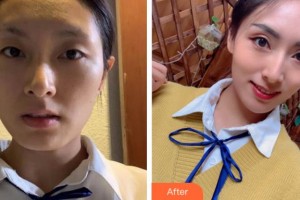 寧波尚麗整形美容醫(yī)院趙其中整形價格表附埋線提升案例展示