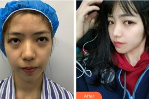 寧波美萊整形美容醫(yī)院劉邦瑜整形價格表附埋線提升案例展示