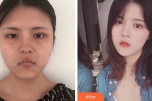 寧波美萊整形美容醫(yī)院馬曉蓬整形價格表附埋線提升案例展示