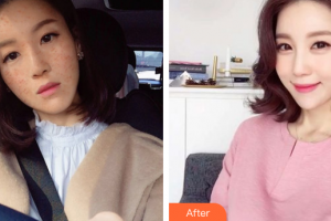 深圳同仁醫(yī)療美容醫(yī)院李斌—整形價格表附清潔祛痘案例展示