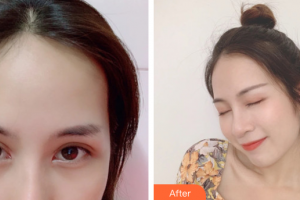 深圳博愛醫(yī)院整形美容中心白云整形價格表附眼部手術(shù)案例展示