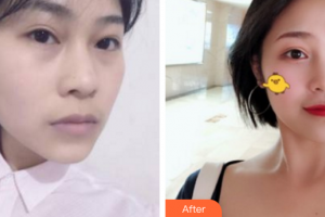 深圳博愛醫(yī)院整形美容中心賀海風(fēng)整形價格表附埋線提升案例展示