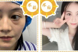 寧波和平博悅美容醫(yī)院尹飛鵬整形價格表附埋線提升案例展示