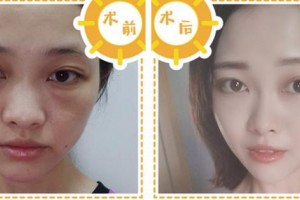 寧波協(xié)和儷人醫(yī)療美容門診部丁芳芳醫(yī)師整形價格表附埋線提升案例展示