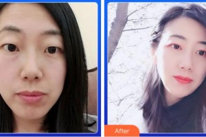 寧波和平博悅美容醫(yī)院金式倫整形價格表附切開雙眼皮案例展示