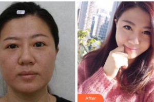 寧波佘雨虹醫(yī)療美容診所佘雨虹整形價格表附埋線雙眼皮案例展示