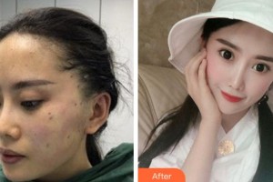 寧波協(xié)和儷人醫(yī)療美容門診部張慧整形價格表附面部提升案例展示