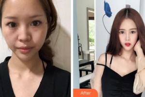 寧波壬美醫(yī)療美容醫(yī)院楊名整形價格表附鼻部綜合案例展示
