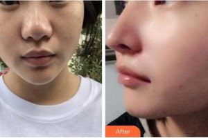 寧波壬美醫(yī)療美容醫(yī)院趙又萱整形價格表附鼻部綜合案例展示