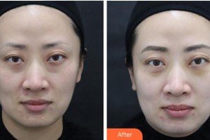 寧波壬美醫(yī)療美容醫(yī)院杜康軍整形價格表附眼部綜合案例展示