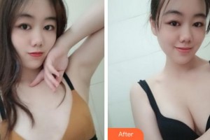 寧波壬美醫(yī)療美容醫(yī)院蔣聰玲整形價格表附自體脂肪隆胸案例展示