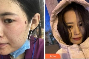 寧波壬美醫(yī)療美容醫(yī)院陳恩霞整形價格表附激光美膚激光案例展示