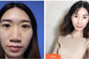 寧波美萊整形美容醫(yī)院韓春整形價格表附鼻部綜合案例展示