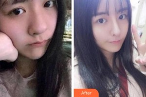 寧波協(xié)和儷人醫(yī)療美容門診部帥霞整形價格表附熱瑪吉案例展示