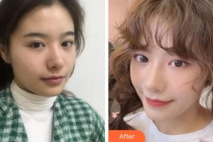 寧波美萊整形美容醫(yī)院李洋整形價格表附熱瑪吉案例展示