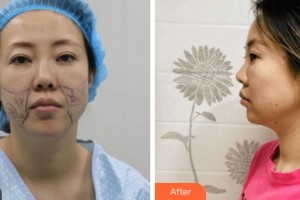 寧波大學醫(yī)學院附屬醫(yī)院整形外科任森洋整形價格表附埋線提升案例展示