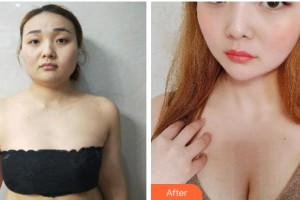 寧波壬美醫(yī)療美容醫(yī)院徐楠整形價格表附自體脂肪隆胸案例展示