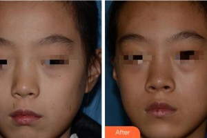 寧波壬美醫(yī)療美容醫(yī)院徐開勇整形價格表附激光點痣案例展示