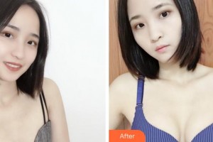 寧波珈禾整形?？漆t(yī)院鄧小榮整形價格表附自體脂肪隆胸案例展示