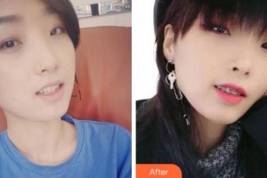 寧波珈禾整形?？漆t(yī)院鮑琴兒整形價格表附金屬托槽矯正案例展示