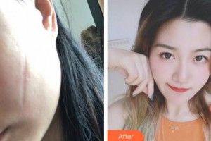 寧波市李惠利醫(yī)院燒傷整形外科金麗華整形價格表附手術祛疤案例展示