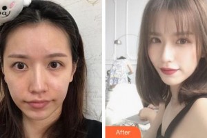 寧波協(xié)和儷人醫(yī)療美容門診部范軍燕整形價(jià)格表附埋線提升案例展示