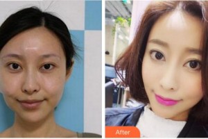 寧波尚麗整形美容醫(yī)院李凖馥整形價(jià)格表附埋線提升案例展示