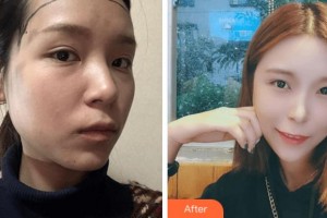 寧波陳標(biāo)新整形美容醫(yī)院金明哲整形價(jià)格表附種植發(fā)際線案例展示