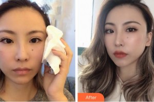 寧波薇琳醫(yī)療美容門診部徐廷五整形價(jià)格表附埋線提升案例展示