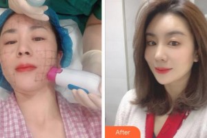 寧波薇琳醫(yī)療美容門診部盧仁鎬整形價(jià)格表附熱瑪吉案例展示