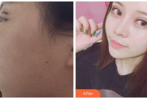 寧波徐建國美容整形醫(yī)院徐建國整形價(jià)格表附眼部綜合案例展示