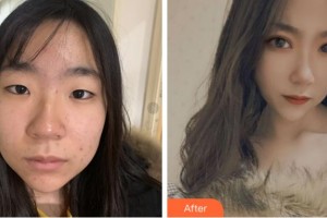 寧波明州醫(yī)院整形美容中心高文彬整形價(jià)格表附埋線雙眼皮案例展示