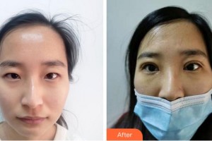 寧波明州醫(yī)院整形美容中心王秉彥整形價(jià)格表附眼部綜合案例展示