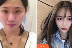 寧波明州醫(yī)院整形美容中心邱育德整形價(jià)格表附眼部綜合案例展示