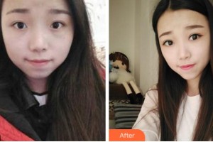 寧波明州醫(yī)院整形美容中心周惠能整形價(jià)格表附切開雙眼皮案例展示