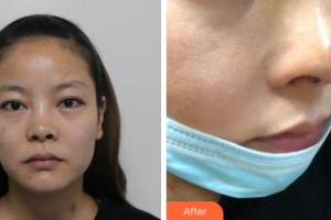 寧波復(fù)大皮膚病?？漆t(yī)院江海鵬整形價(jià)格表附鼻部綜合案例展示