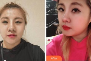 寧波復(fù)大皮膚病?？漆t(yī)院王安平整形價(jià)格表附熱瑪吉案例展示