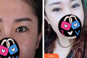 寧波韓美醫(yī)療美容門診部黃艷紅整形價(jià)格表附眼部修復(fù)案例展示