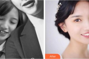 寧波江北口腔醫(yī)院柱整形價(jià)格表附金屬托槽矯正案例展示