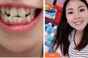 寧波江北口腔醫(yī)院李幼華整形價(jià)格表附金屬托槽矯正案例展示