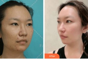 寧波美塑醫(yī)療美容門診部湯朝陽(yáng)整形價(jià)格表附切開(kāi)雙眼皮案例展示