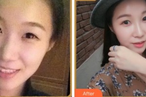 寧波美塑醫(yī)療美容門診部王學(xué)軍整形價(jià)格表附熱瑪吉案例展示