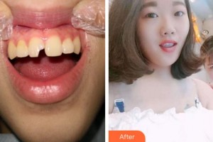 寧波拜博拜爾口腔醫(yī)院吉東整形價(jià)格表附美白貼片案例展示