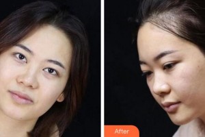 寧波鄞州眼科醫(yī)院程軍英整形價(jià)格表附眼部綜合案例展示