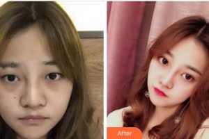 寧波鄞州眼科醫(yī)院陳彥整形價(jià)格表附切開(kāi)雙眼皮案例展示