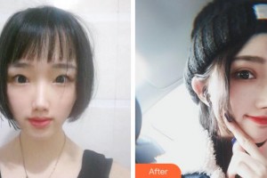 寧波鄞州眼科醫(yī)院鄭志斌整形價格表附切開雙眼皮案例展示