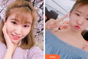 寧波市中醫(yī)院醫(yī)療美容科陳寧剛整形價格表附切開雙眼皮案例展示