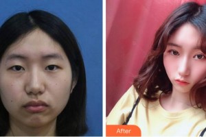 寧波市中醫(yī)院醫(yī)療美容科葉姝整形價格表附眼部整形案例展示