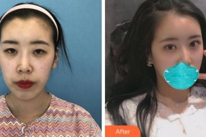 寧波市北侖區(qū)人民醫(yī)院眼科韓偉整形價格表附眼部綜合案例展示